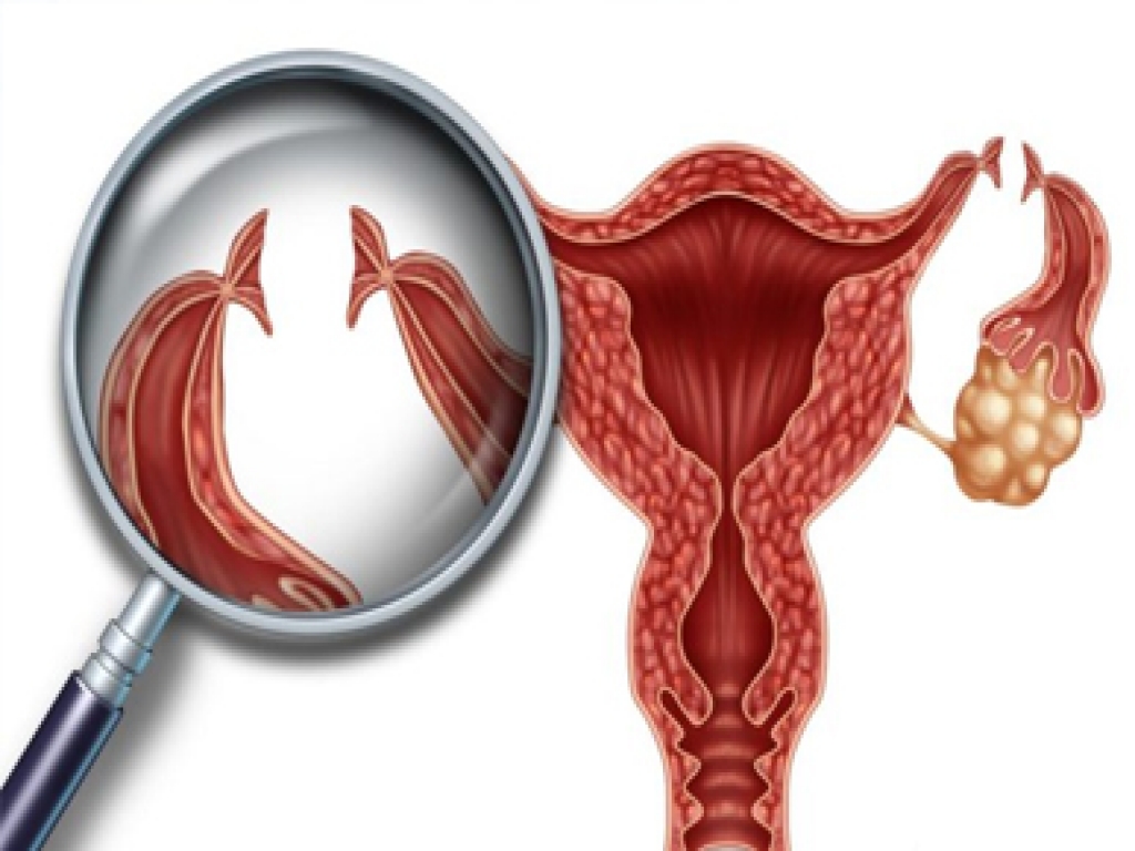 Tüp Ligasyonu (Tüp Bağlama Operasyonları)